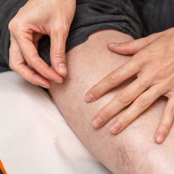 Dry Needling Therapy