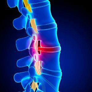 x-ray of herniated disc