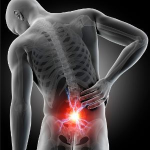 Pinched Nerve Example