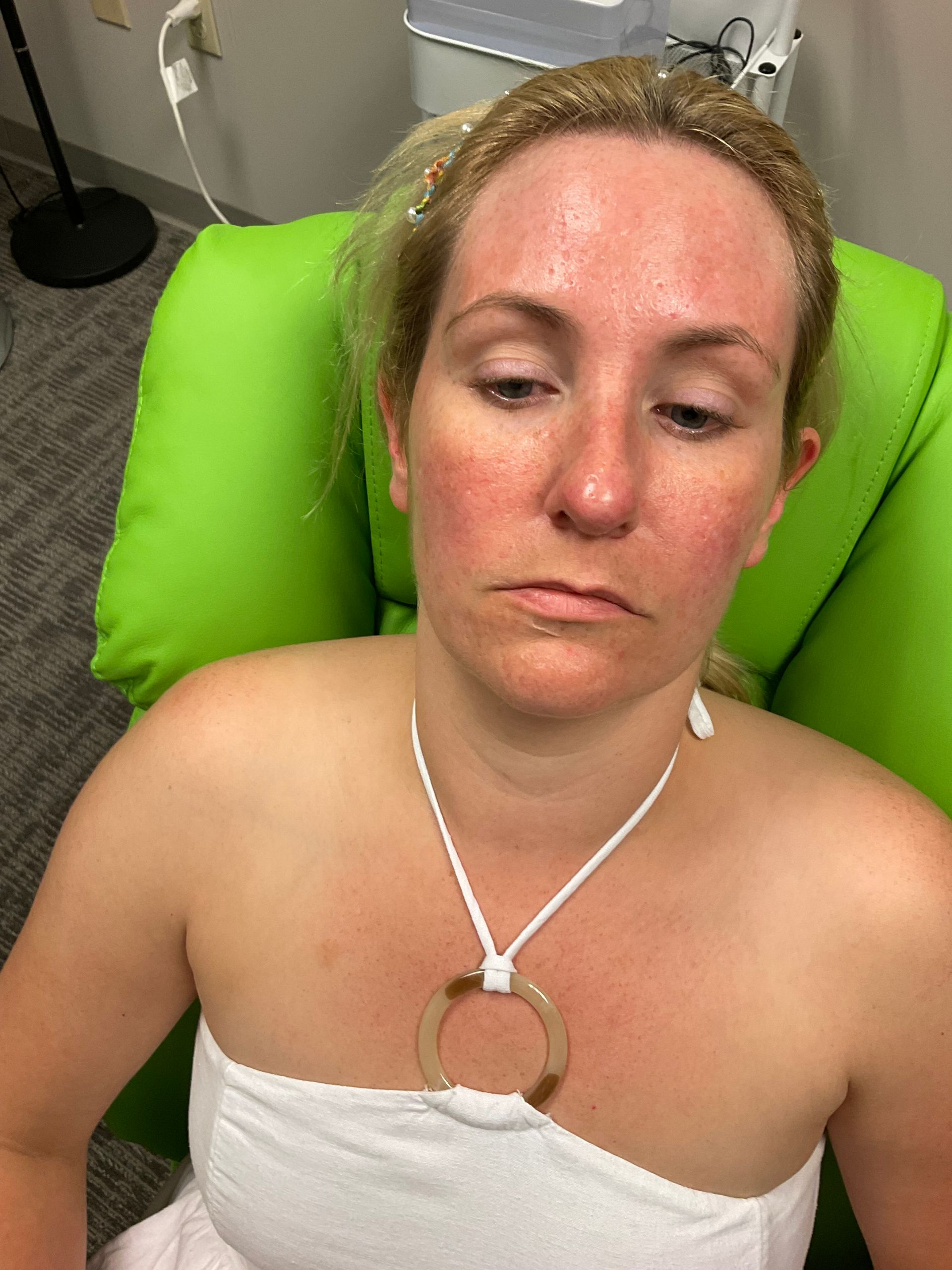 Woman with red skin, sitting in a green chair. She wears a necklace and a white towel. Indoors with medical equipment.