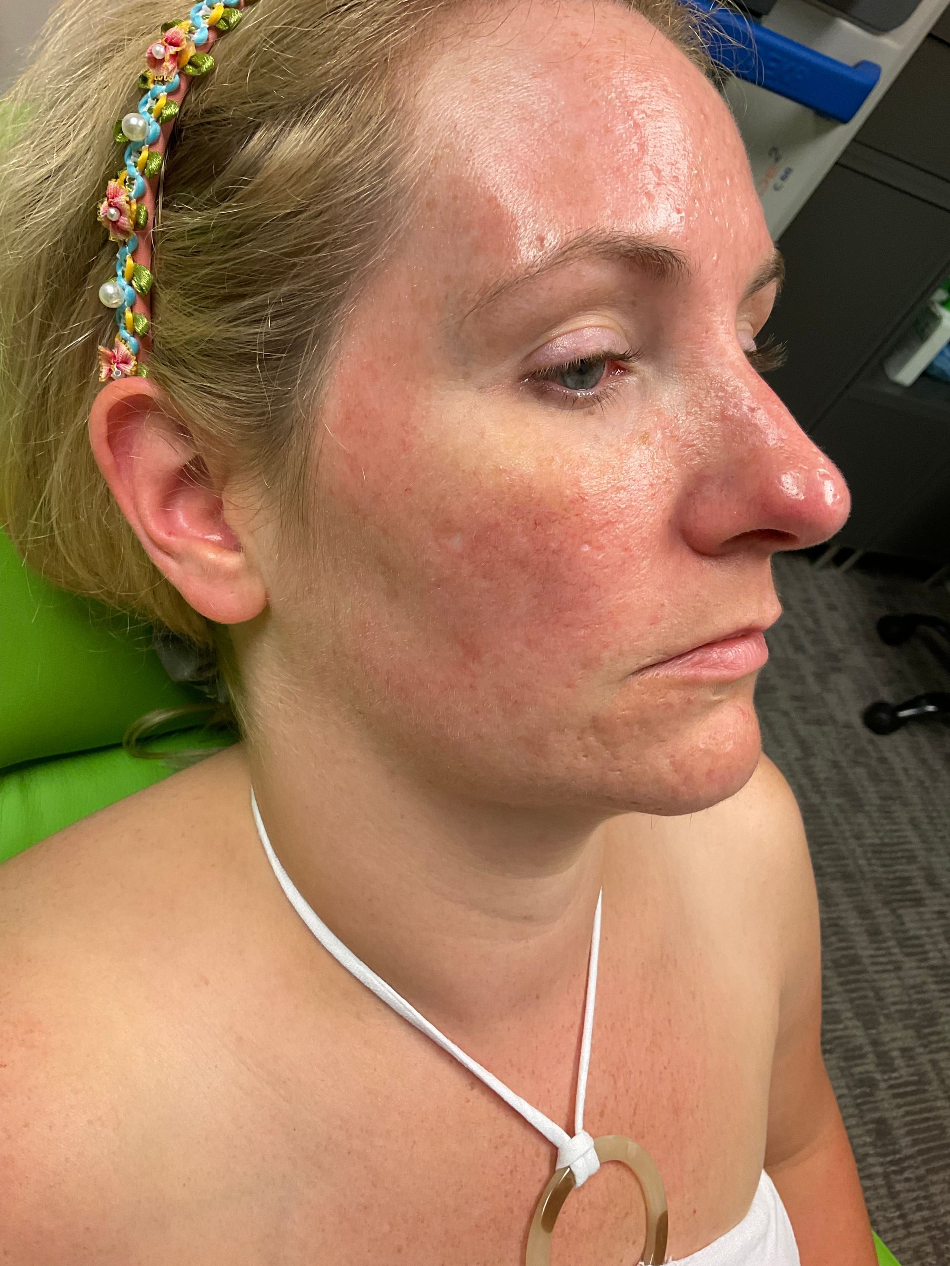 Woman with red, irritated skin wearing a headband and white necklace. Her face is turned to the side.