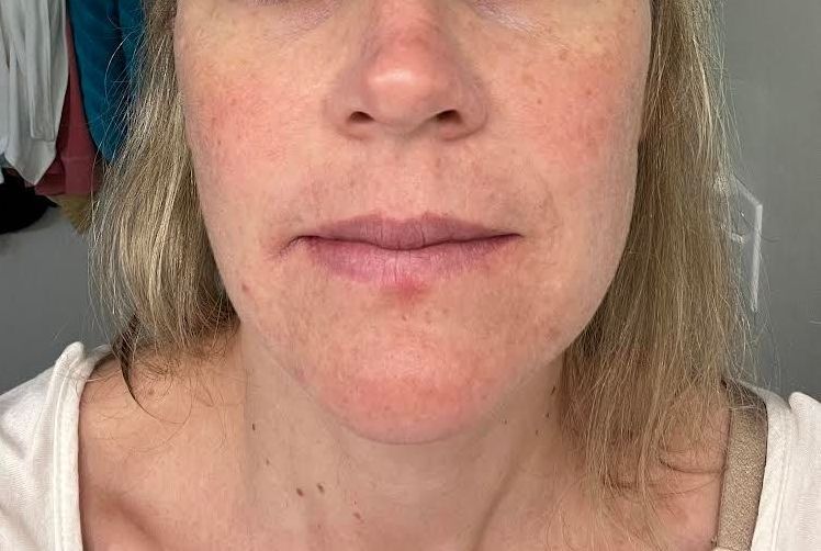 Woman's face close-up, fair skin, light hair, looking forward, with visible pores and slight redness.
