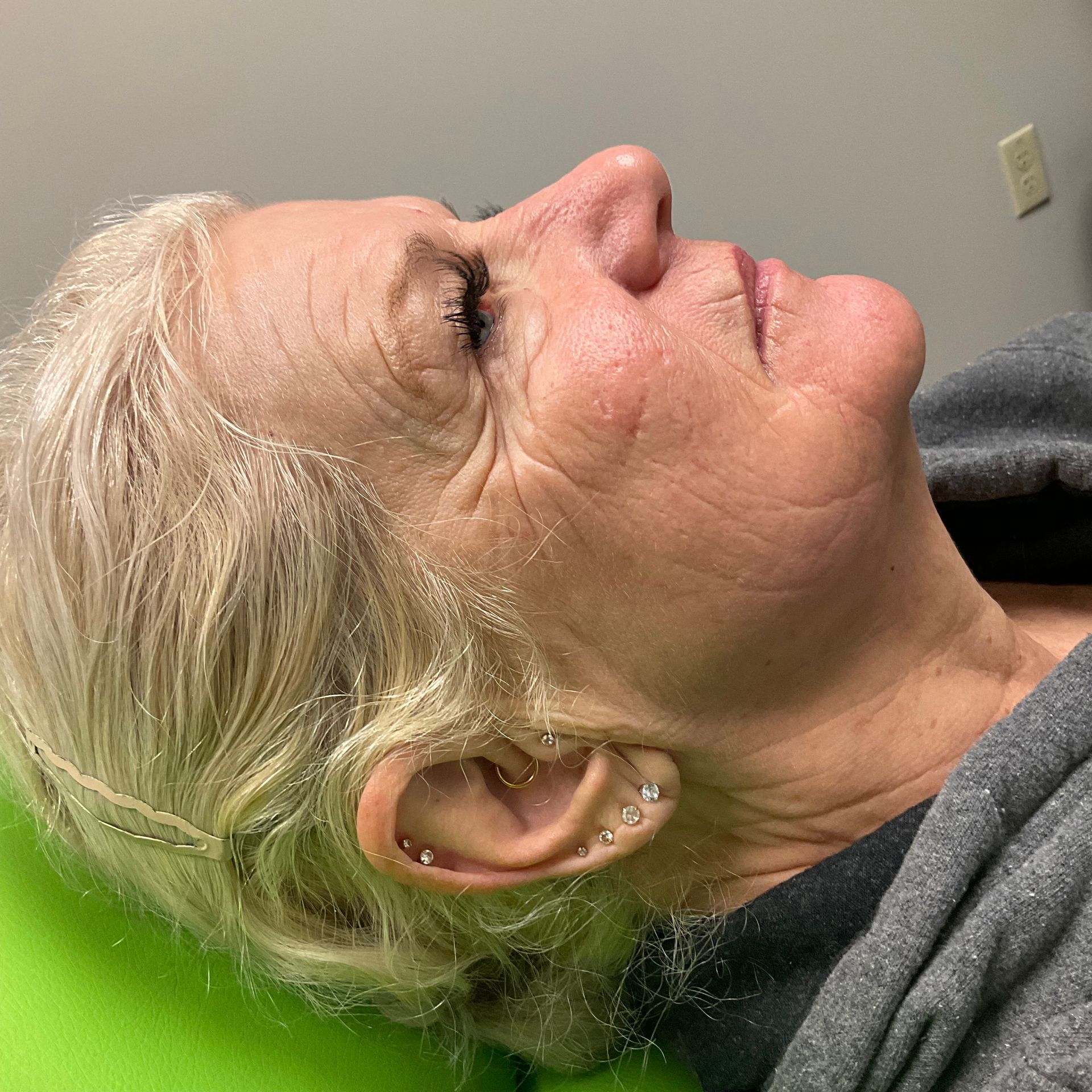 Profile view of a person with light hair and wrinkles, lying down, in a treatment setting.