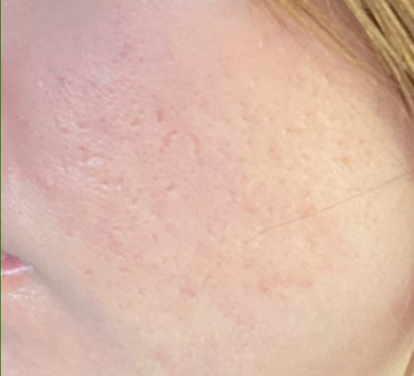Close-up of a person's cheek with noticeable acne scars and uneven skin texture.