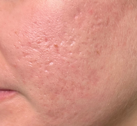 Close-up of a person's cheek with visible acne scars, red skin, and texture.