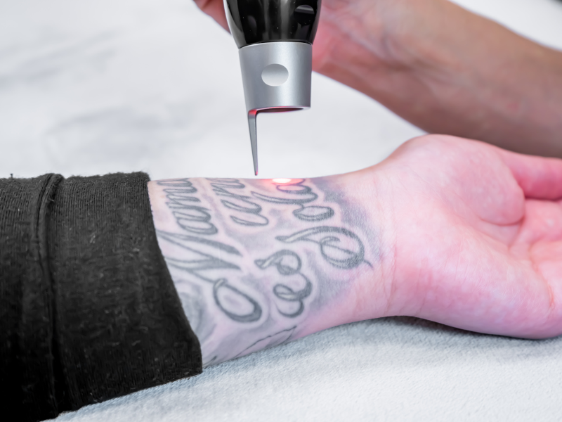 Laser tattoo removal on a wrist, emitting red light. Person holding device over a tattoo.