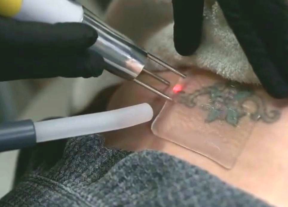 Laser tattoo removal on neck: red laser light, hand in glove, tattoo partially covered.