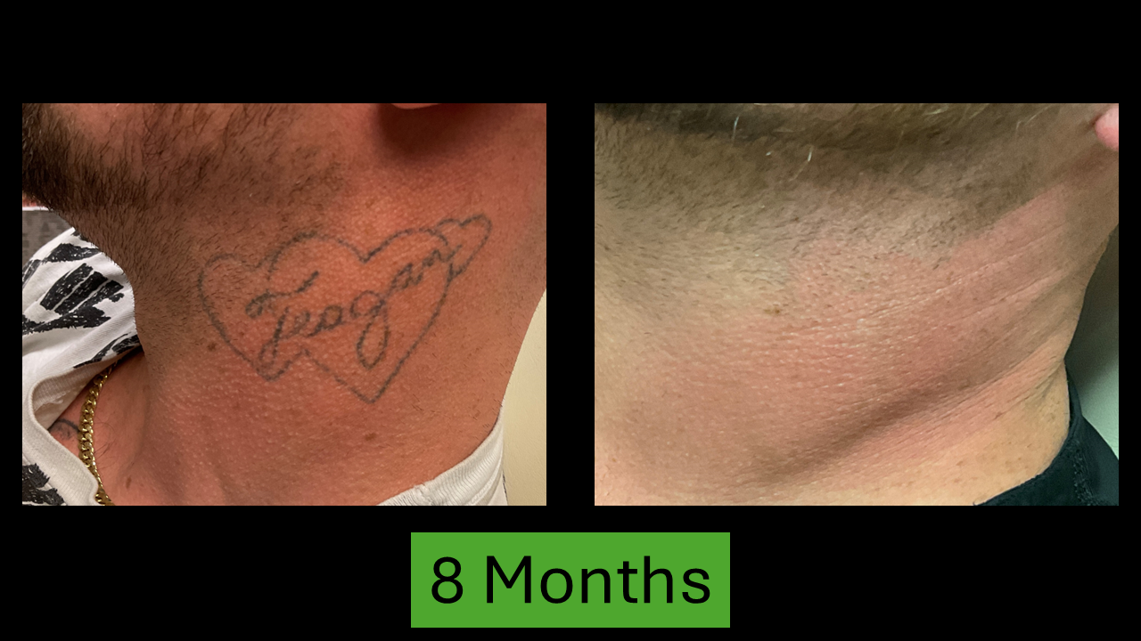 Comparison of tattoo removal results: Before and after 8 months.