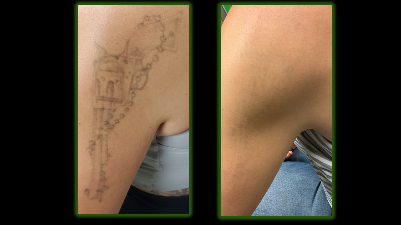 Before and after of tattoo removal. The tattoo of a gun is gone after laser treatments.