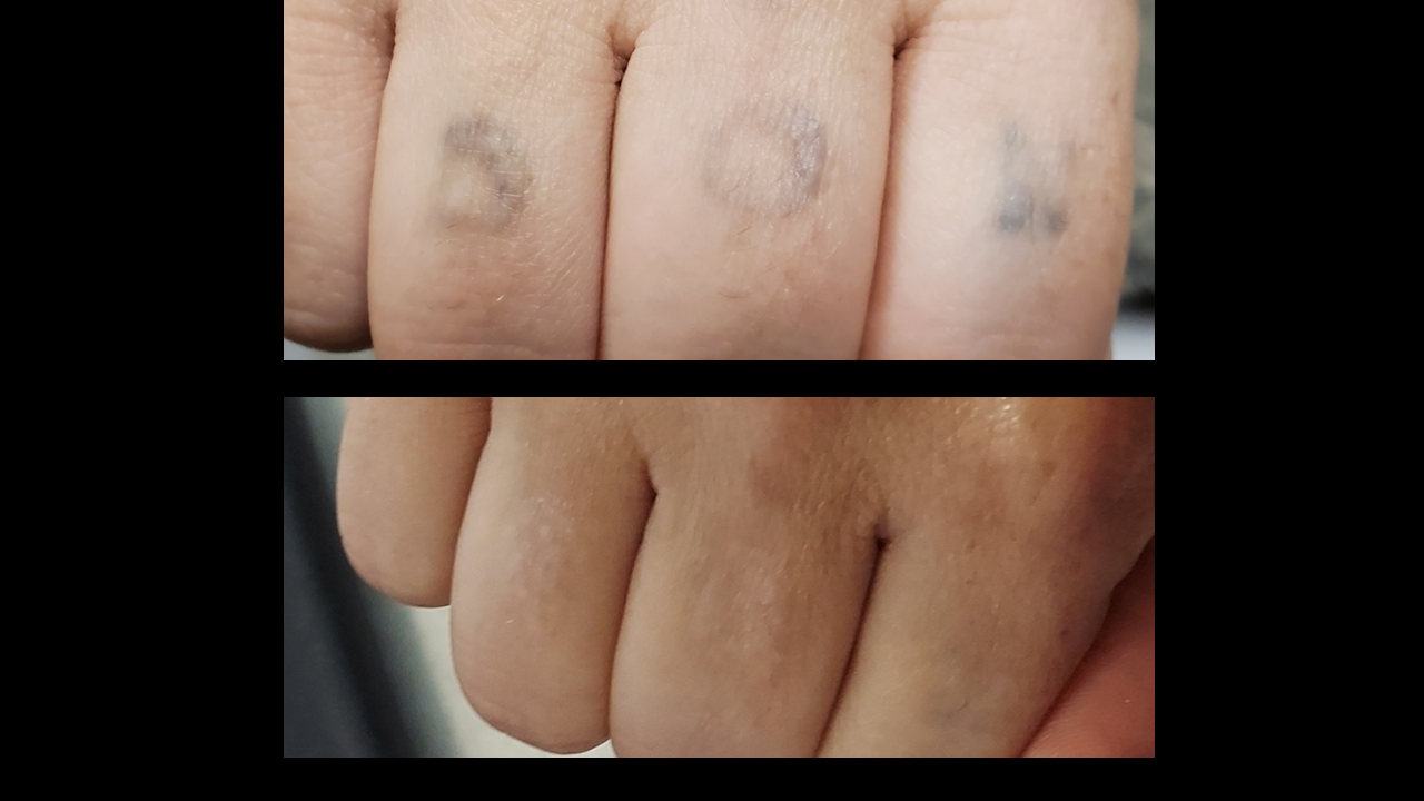 Comparison of fingers: top shows faded tattoos of numbers, bottom shows clear skin.