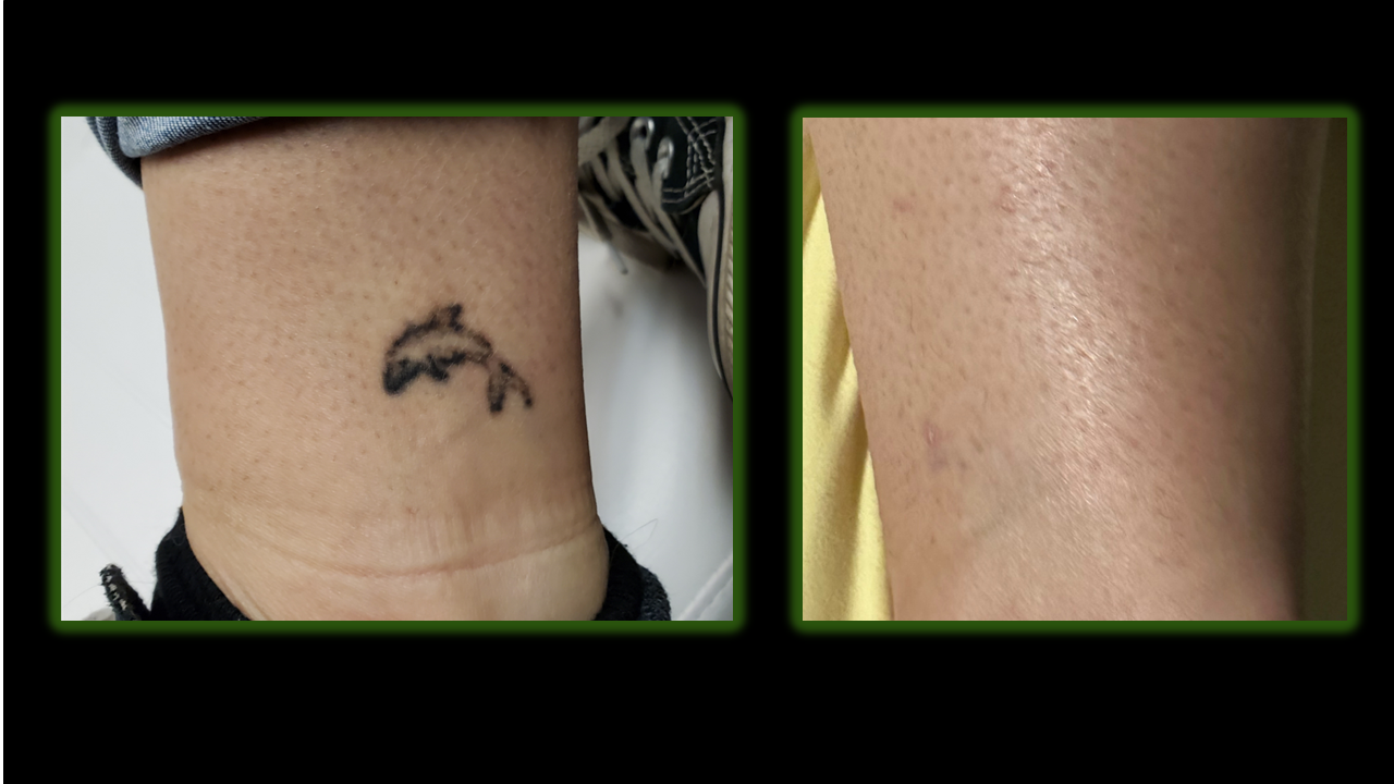 Before and after images of a dolphin tattoo on an ankle, with the after showing faded skin.