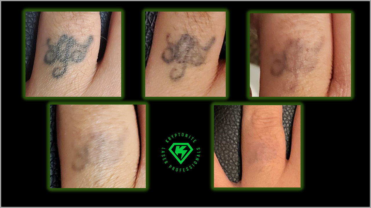 Progression of a tattoo fading over time. From initial design to near-complete removal.