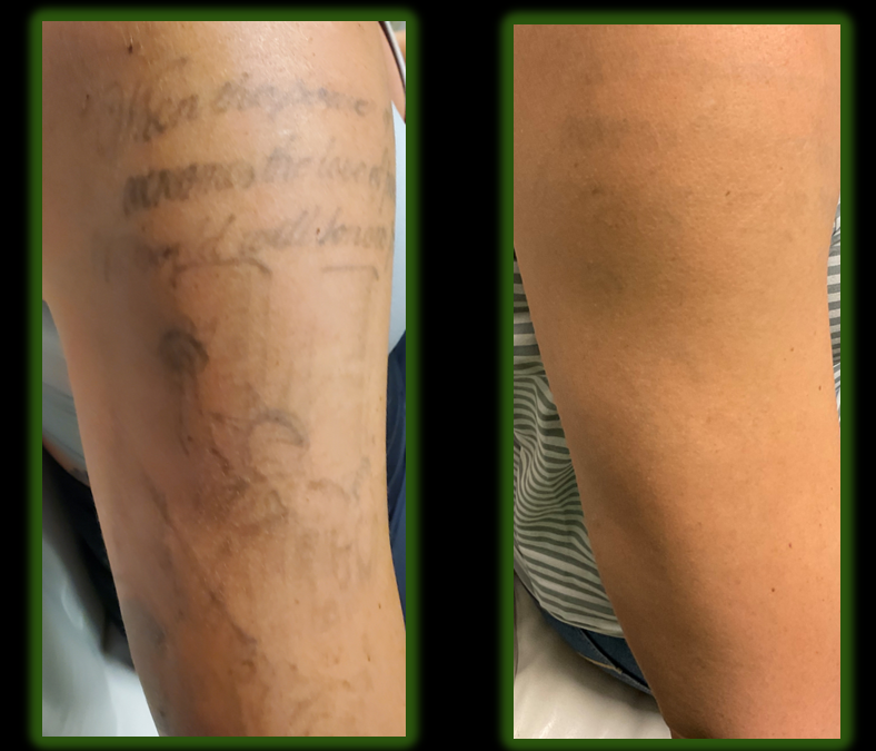 Arm with tattoo before and after laser removal, showing significant fading.