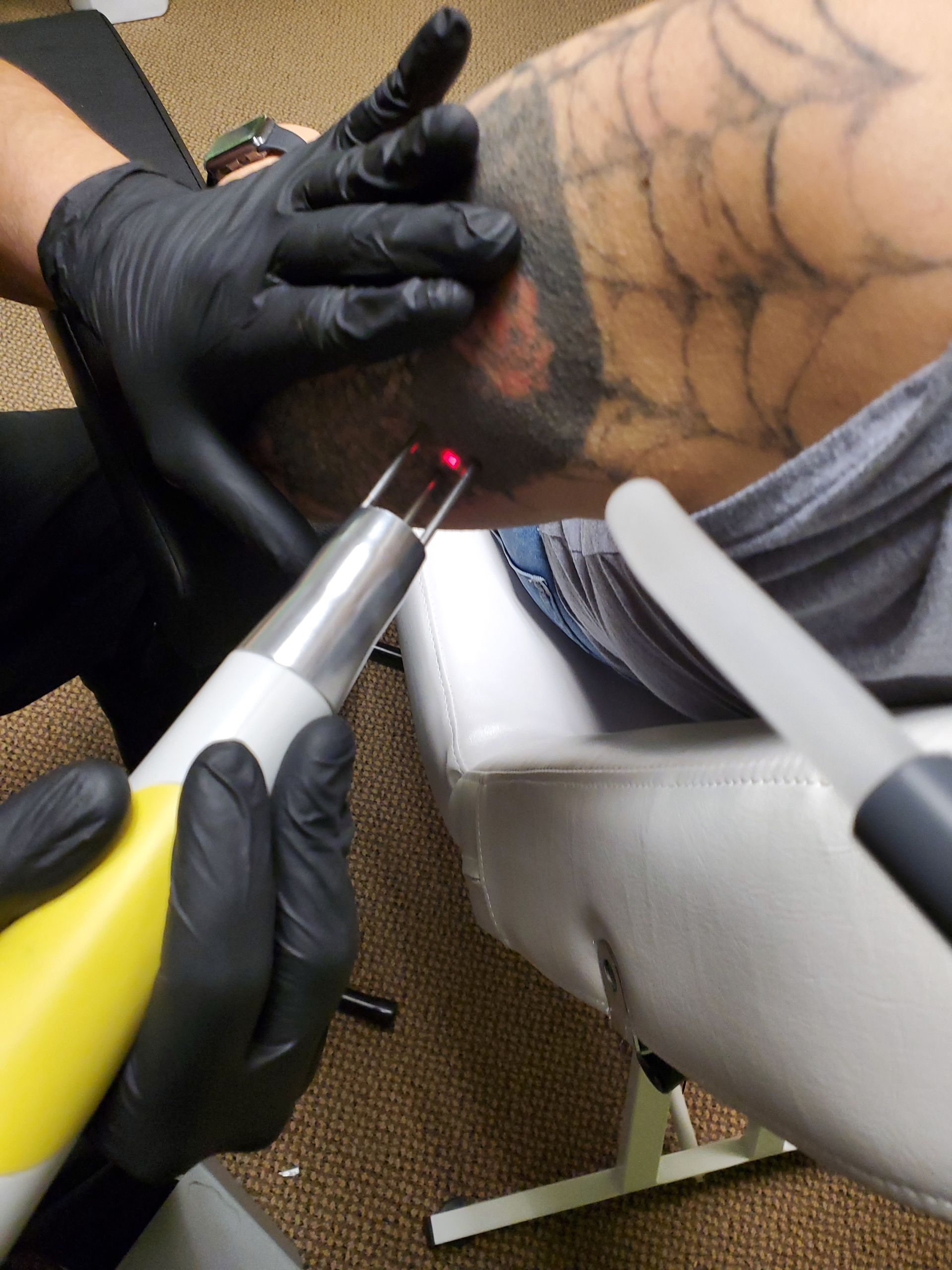 Laser tattoo removal on leg, black gloved hands operate machine, emitting red light. Spiderweb tattoo visible.