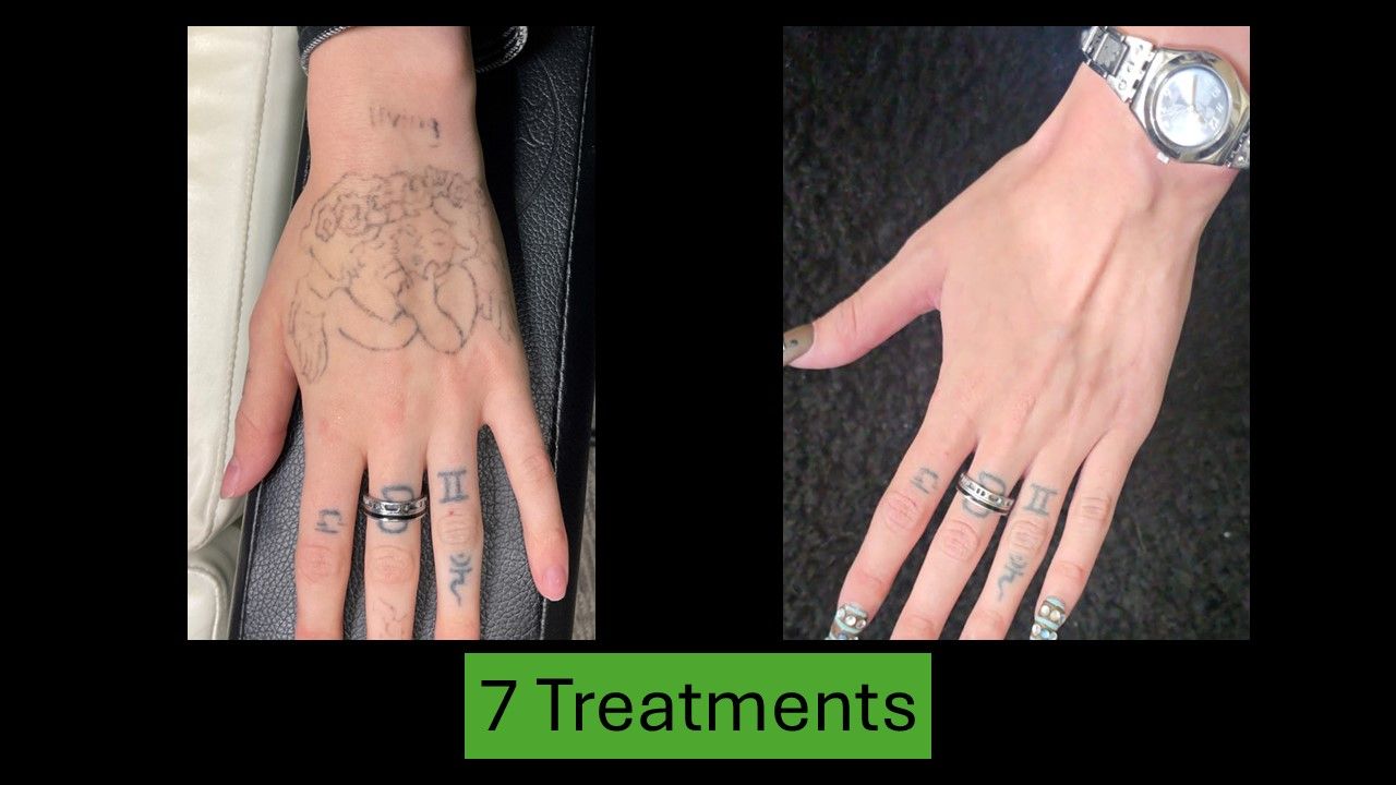 Before and after photos of tattoo removal on a hand after 7 treatments; tattoo fades significantly.