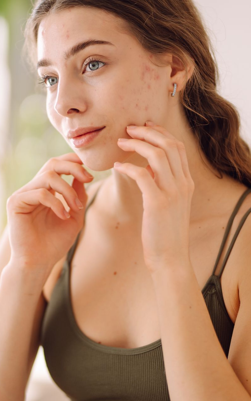 Woman touching face, looking towards the left, with blemishes on her cheek, wearing a green tank top.