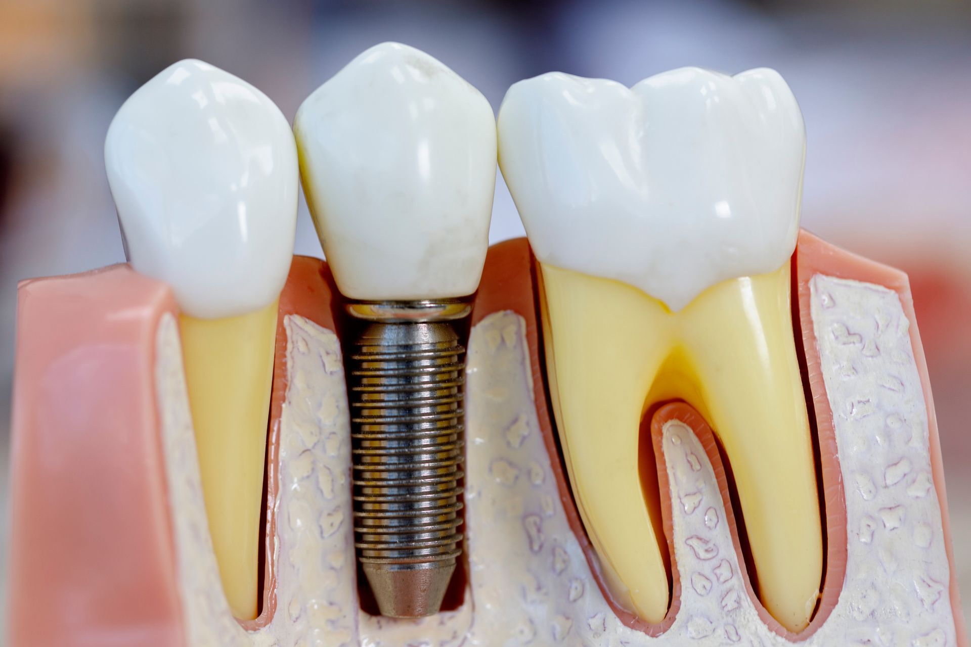 A model of a tooth with a dental implant in it.