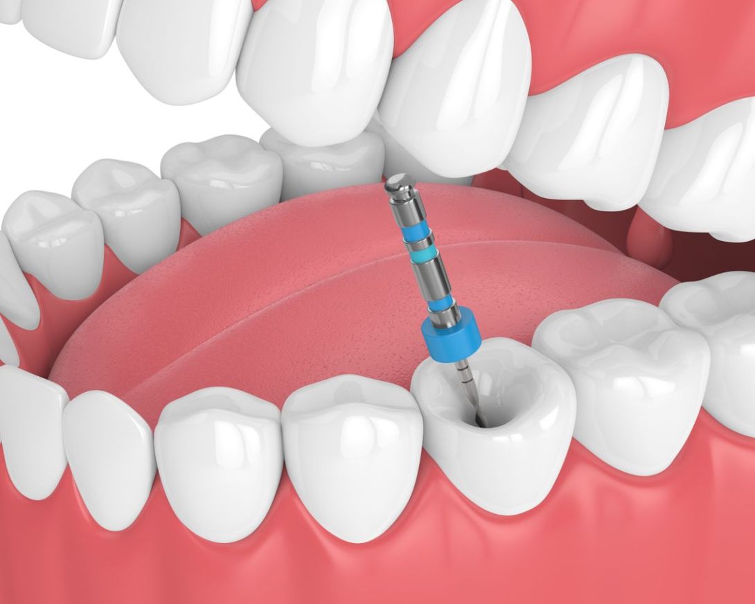 cura caria dentale