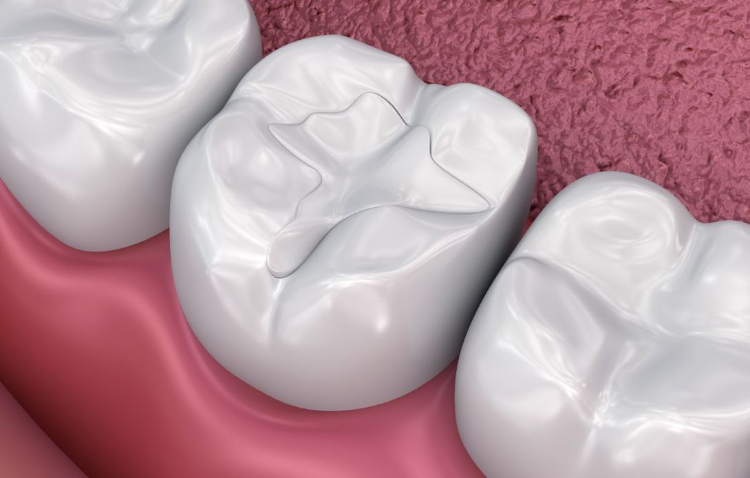trattamento di endodonzia