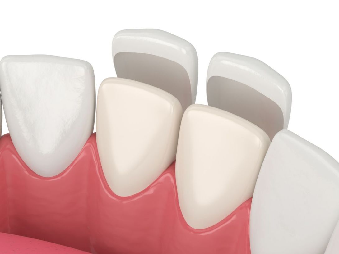 applicazione faccette dentali