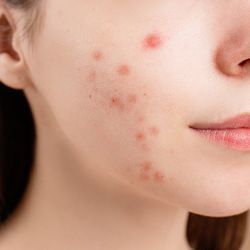 Acne behandeling Nijmegen Winssen