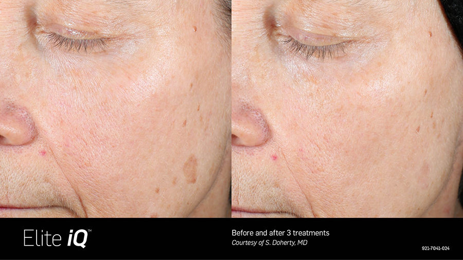 A before and after photo of a woman 's face.