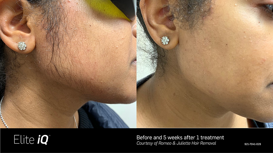 A before and after photo of a woman 's face.