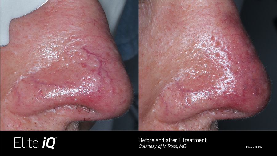 A before and after photo of a person 's nose with veins.