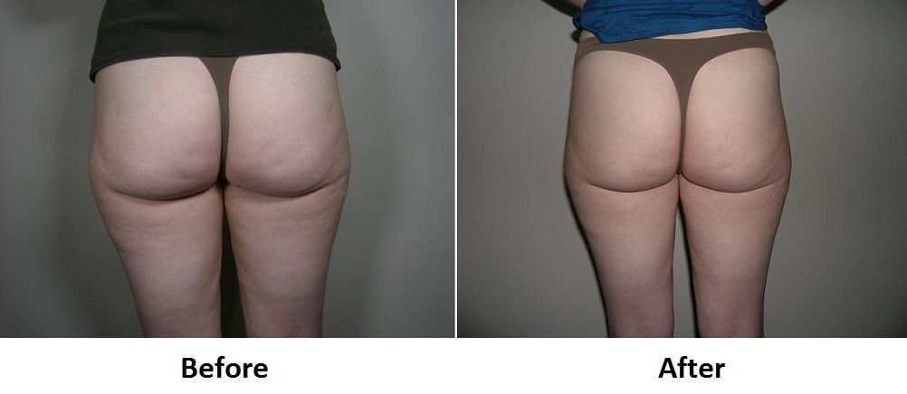 before and after