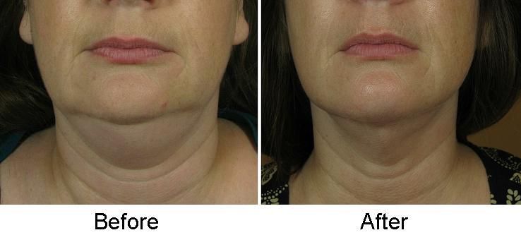 Ease of Microchanneling Treatments for Skin Tightening