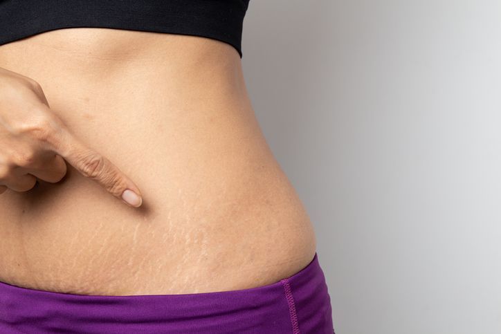Stretch Mark Treatment Options