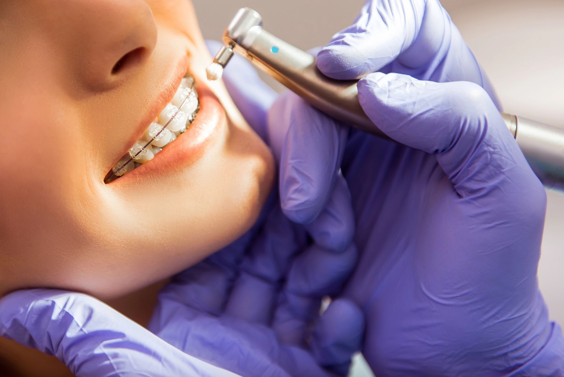 Un dentista lucida l'apparecchio ortodontico sui denti di un paziente con uno strumento odontoiatrico e guanti viola.