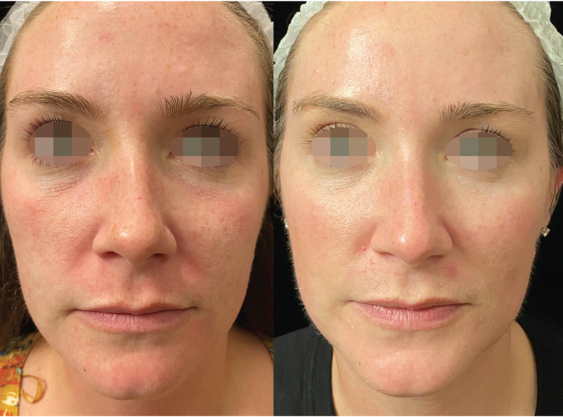 A before and after photo of a woman 's face.