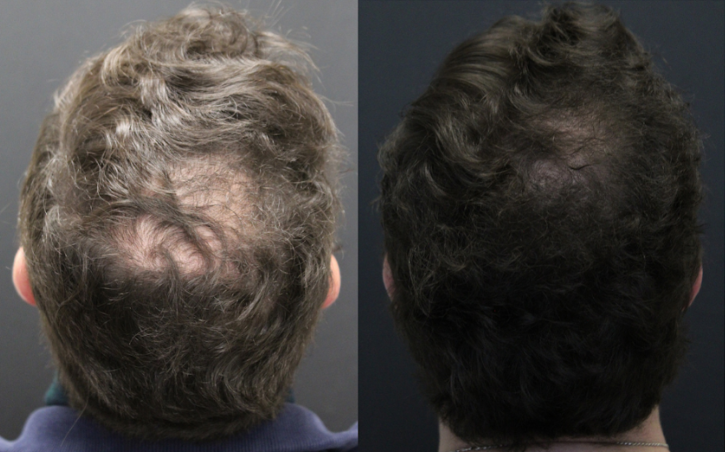 A before and after picture of a man 's hair growth.