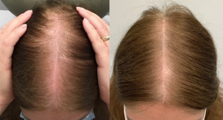 A before and after photo of a woman 's hair growth.