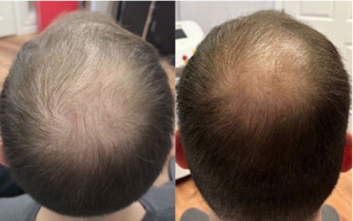 A before and after picture of a man 's hair growth.