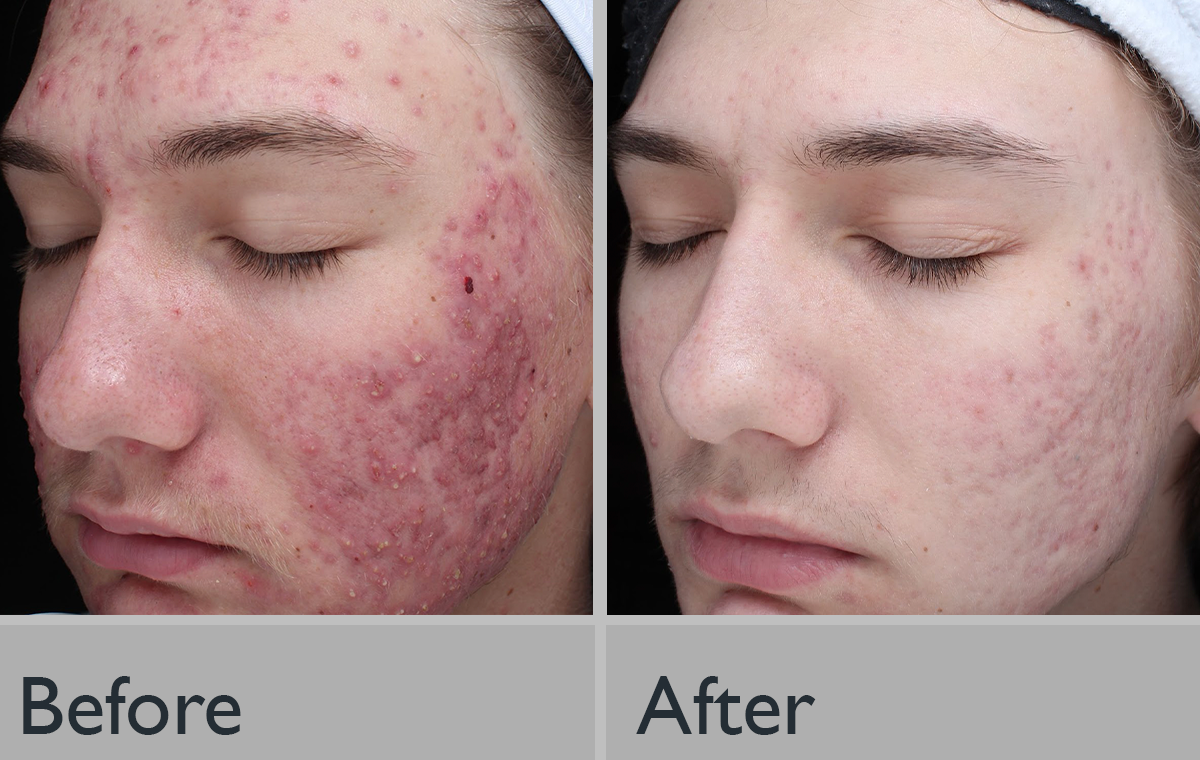 Before/After Chemical Peel