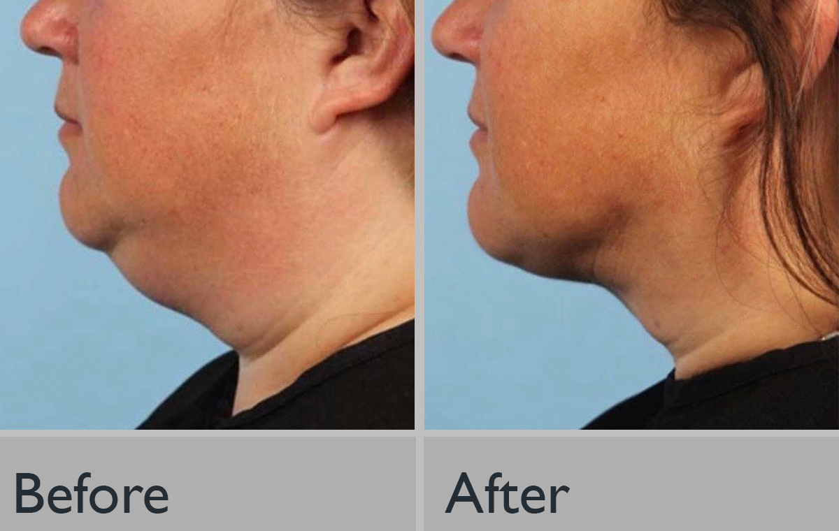 A before and after photo of a woman 's neck and face