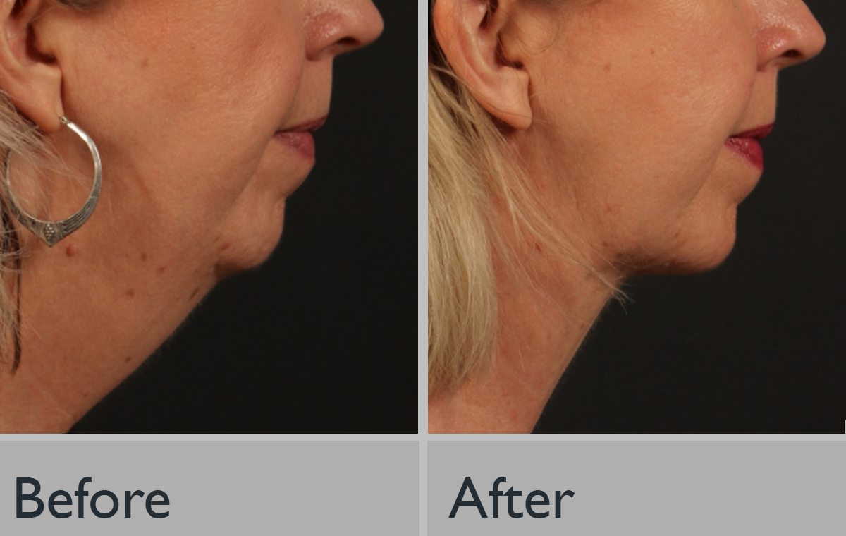 A before and after photo of a woman 's face