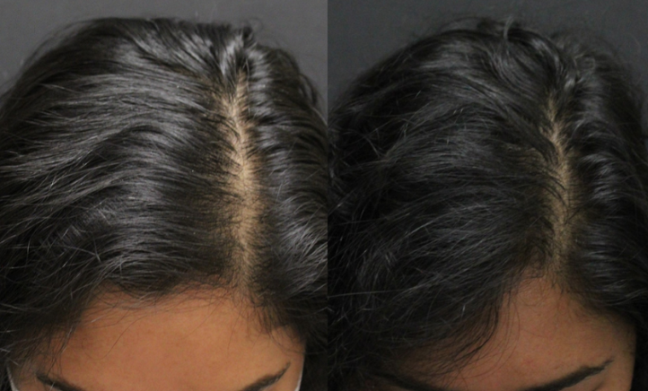A before and after photo of a woman 's hair growth.