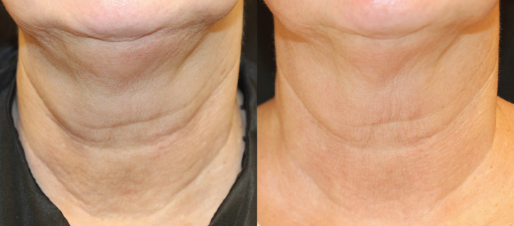 There is a before and after picture of a woman 's neck.