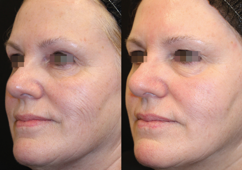opus before/after