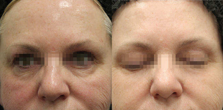 opus before/after