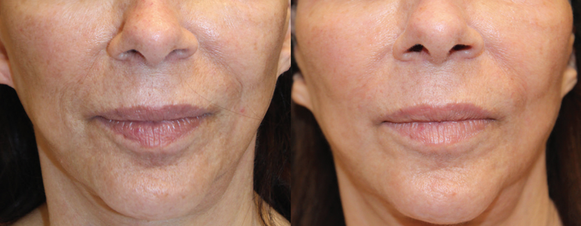 opus before/after