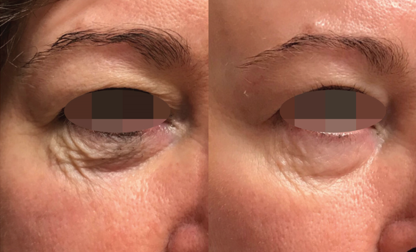 opus before/after