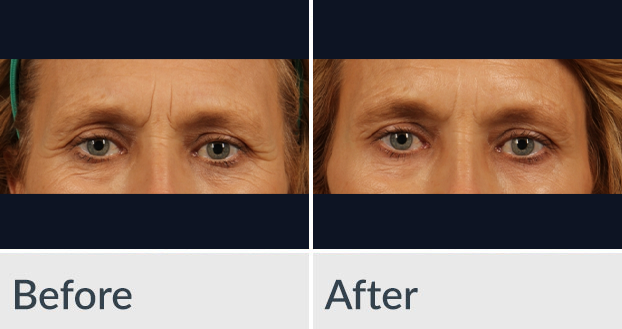 A before and after photo of a woman's wrinkles