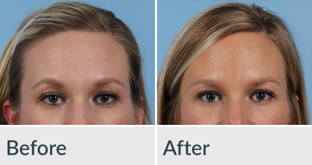 A before and after photo of a woman 's forehead
