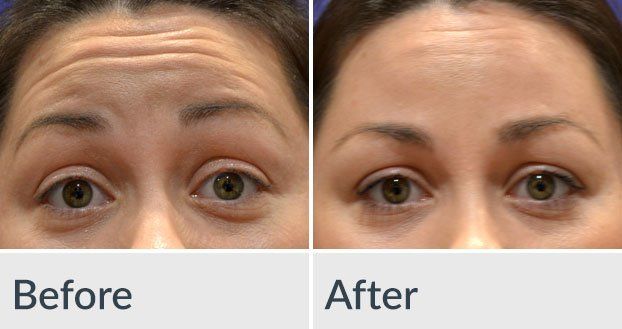 A before and after photo of a woman 's forehead