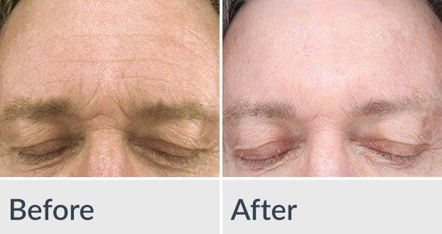 A before and after photo of a man 's forehead with his eyes closed.