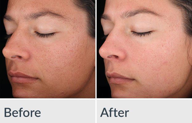 Before/After Chemical Peel